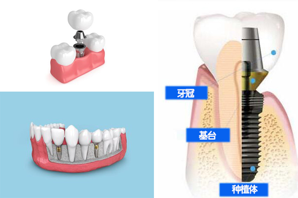 种植牙价格