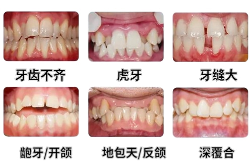 合肥牙齿矫正、牙齿矫正价格、佳德口腔整牙
