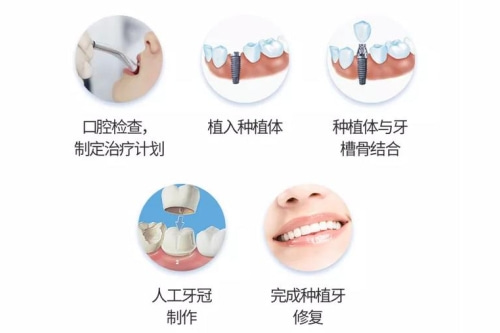 合肥种植牙齿、佳德口腔种牙