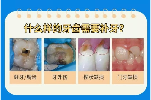 合肥补牙医院、佳德口腔补牙价格