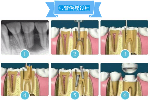 合肥根管的治疗、佳德口腔根管收费