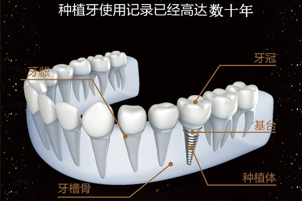 种植体系统