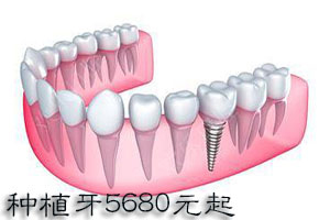 种植牙单颗优惠价4680元，种1颗送1颗