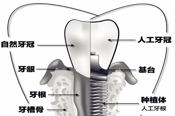 合肥种植牙多少钱