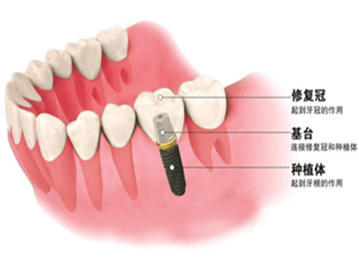 合肥种植牙费用多少？