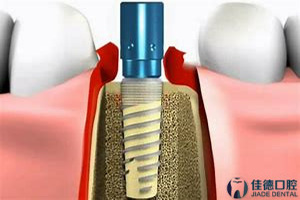 合肥佳德口腔种植牙