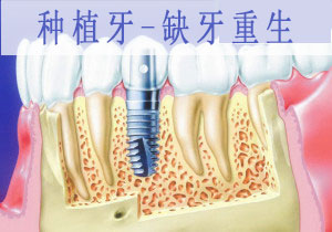 种植牙的寿命