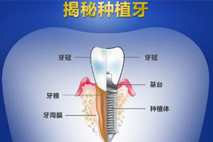 合肥种植牙哪家好