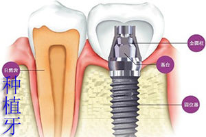 种植牙大概多少钱？