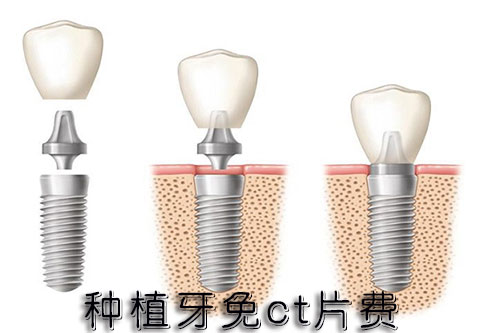 合肥种牙需要多少钱？