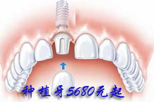 合肥种一颗牙需要多少钱？