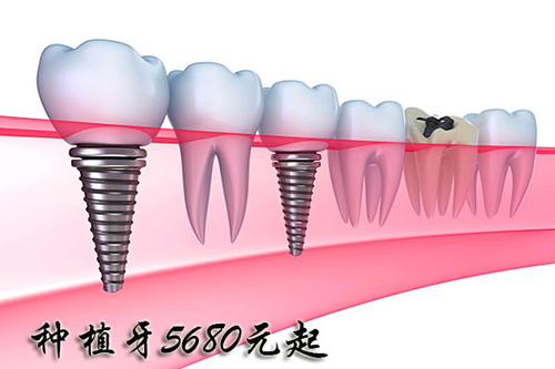 合肥种植牙价钱多少