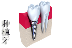 合肥种植牙价格多少钱？