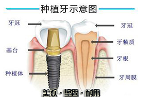 种植牙多少钱一颗？
