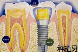 合肥做种植牙可靠安全吗？