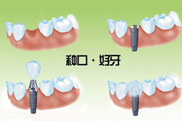 合肥种植牙的特点