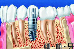 合肥种植牙多少钱?_合肥种植牙一颗需多少钱？