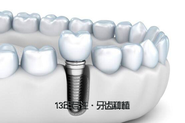 关于种植牙基台的介绍？