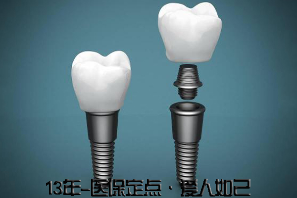 关于种植牙的寿命究竟有多长？