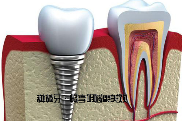 为什么现代人都选择种植牙做牙齿修复？