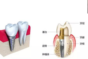 “传统式假牙”与“人工牙根支持式假牙”的区别？