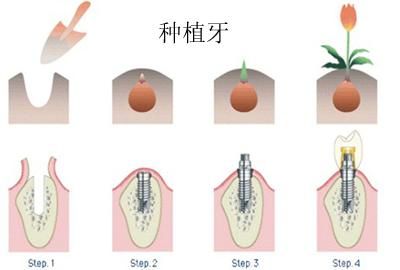 合肥种植牙价钱