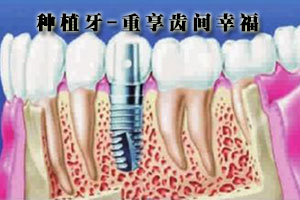 牙龈萎缩可以做种植牙么