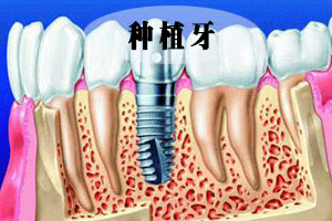 合肥种植牙多少钱?