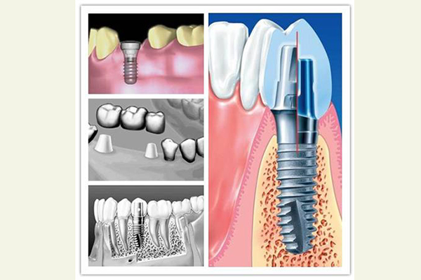 种植牙