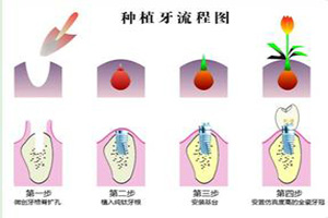 合肥种植牙过程