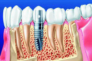 种植牙的危害？