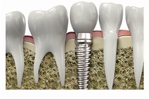 种植牙