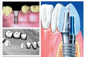 种植牙的优点