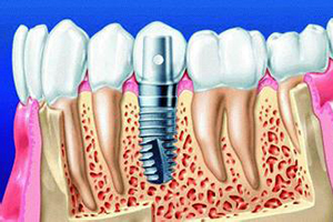 合肥口腔 种植牙？