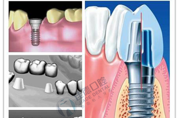 盘点种植牙的7大认识误区？