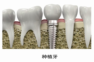 种植牙的价格需要多少钱?