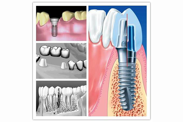 种植牙