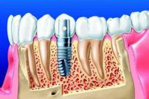 种植牙护理