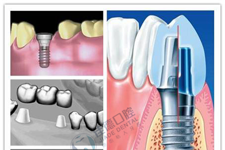 牙齿缺失后种牙好不好？