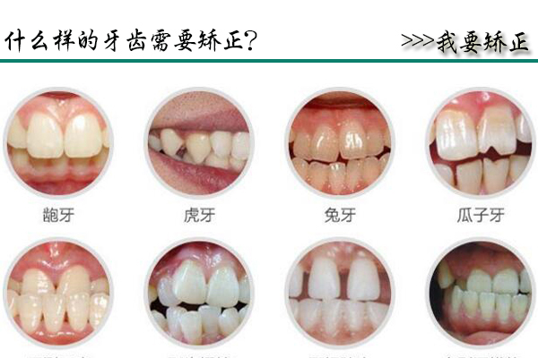 合肥牙齿矫正
