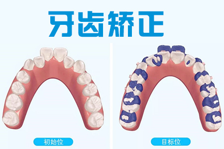 牙齿矫正拔牙