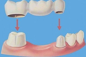 什么是牙冠修复？