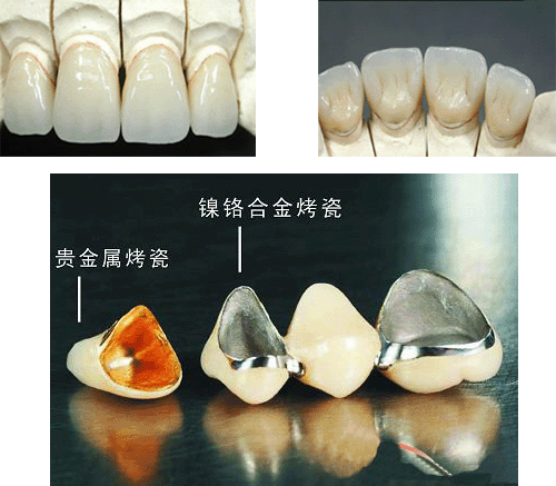 烤瓷牙的价格为何相差颇大？