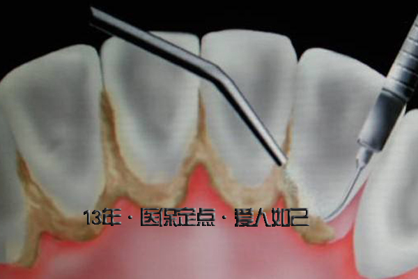 合肥洗牙多少钱？