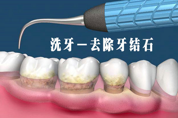 洗牙注意事项