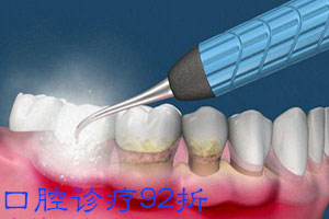 合肥洗牙多少钱?