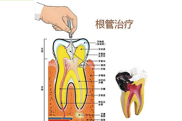 根管的治疗