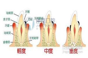 牙齿疾病的修复治疗有哪些？