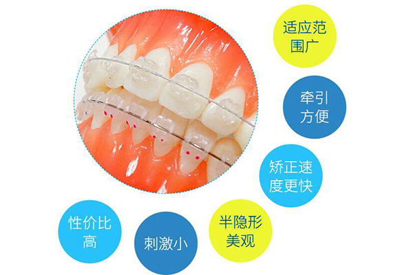 半隐形矫正价格