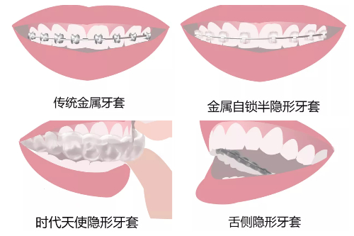 合肥牙齿矫正年龄